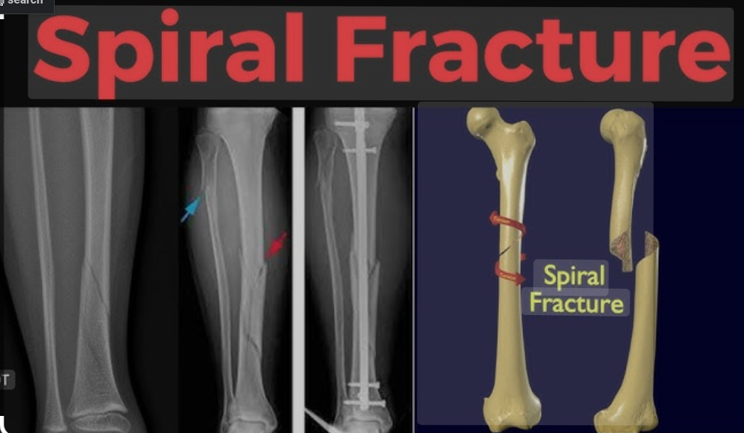 SpiralFracture